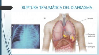 RUPTURA TRAUMÁTICA DEL DIAFRAGMA
 