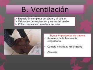 B. Ventilación
 Exposición completa del tórax y el cuello
 Valoración de respiración y venas del cuello
 Collar cervical con apertura anterior
Signos importantes de trauma
• Aumento de la frecuencia
respiratoria
• Cambio movilidad respiratoria
• Cianosis
 