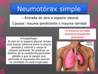 Neumotórax simple
 Entrada de aire a espacio pleural
Causas: trauma penetrante o trauma cerrado
el trauma cerrado
produce laceración
pulmonar•Fisiopatlogia:
El aire en el espacio pleural rompe
esta fuerza cohesiva entre la pleura
parietal y visceral y causa el
colapso pulmonar. Se produce un
defecto de la ventilación/perfusión
debido a que la sangre que
perfunde el segmento del pulmón
no ventilado no está oxigenada.
 
