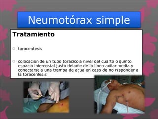 Neumotórax simple
Tratamiento
 toracentesis
 colocación de un tubo torácico a nivel del cuarto o quinto
espacio intercostal justo delante de la línea axilar media y
conectarse a una trampa de agua en caso de no responder a
la toracentesis
 