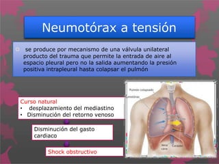 Neumotórax a tensión
 se produce por mecanismo de una válvula unilateral
producto del trauma que permite la entrada de aire al
espacio pleural pero no la salida aumentando la presión
positiva intrapleural hasta colapsar el pulmón
Curso natural
• desplazamiento del mediastino
• Disminución del retorno venoso
Disminución del gasto
cardiaco
Shock obstructivo
 