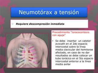 Neumotórax a tensión
 Requiere descompresión inmediata
Procedimiento “toracocentesis
con aguja”
• Se debe insertar un cateter
avocath en el 2do espacio
intercostal sobre la linea
media clavicular del hemitorax
afectado, en caso de no dar
resultados se debe colocar un
tubo torácico en el 5to espacio
intercostal anterior a la línea
media axilar
 