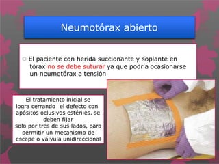 Neumotórax abierto
 El paciente con herida succionante y soplante en
tórax no se debe suturar ya que podría ocasionarse
un neumotórax a tensión
El tratamiento inicial se
logra cerrando el defecto con
apósitos oclusivos estériles. se
deben fijar
solo por tres de sus lados, para
permitir un mecanismo de
escape o válvula unidireccional
 