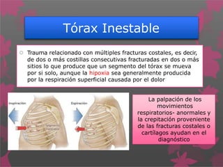 Tórax Inestable
 Trauma relacionado con múltiples fracturas costales, es decir,
de dos o más costillas consecutivas fracturadas en dos o más
sitios lo que produce que un segmento del tórax se mueva
por si solo, aunque la hipoxia sea generalmente producida
por la respiración superficial causada por el dolor
La palpación de los
movimientos
respiratorios- anormales y
la crepitación proveniente
de las fracturas costales o
cartílagos ayudan en el
diagnóstico
 