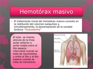 Hemotórax masivo
 El tratamiento inicial del hemotórax masivo consiste en
la restitución del volumen sanguíneo y,
simultáneamente, la descompresión de la cavidad
torácica “Toracostomia”
El tubo se inserta
atreves de la línea
axilar anterior o
axilar media entre el
4to espacio
intercostal cuando se
trata de neumotórax
y entre el 5to y el 6to
espacio cuando se
trata de hemotórax
 