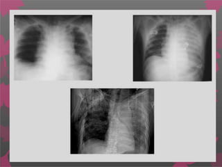 Ruptura Traumática de
Aorta
 