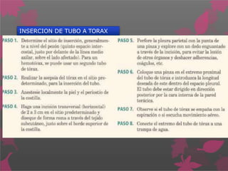 INSERCION DE TUBO A TORAX
 