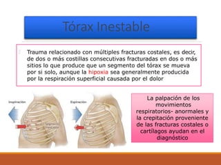 Trauma de torax | PPTX