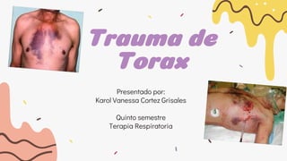 Trauma de
Torax
Presentado por:
Karol Vanessa Cortez Grisales
Quinto semestre
Terapia Respiratoria
 