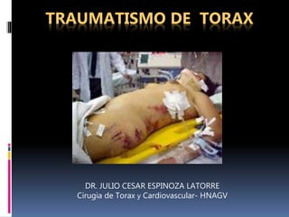 TRAUMATISMO DE TORAX
DR. JULIO CESAR ESPINOZA LATORRE
Cirugia de Torax y Cardiovascular- HNAGV
 