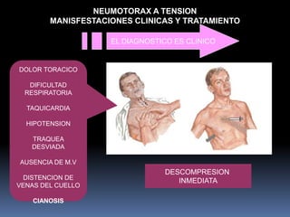 NEUMOTORAX A TENSION
MANISFESTACIONES CLINICAS Y TRATAMIENTO
DOLOR TORACICO
DIFICULTAD
RESPIRATORIA
TAQUICARDIA
HIPOTENSION
TRAQUEA
DESVIADA
AUSENCIA DE M.V
DISTENCION DE
VENAS DEL CUELLO
CIANOSIS
EL DIAGNOSTICO ES CLINICO
DESCOMPRESION
INMEDIATA
 