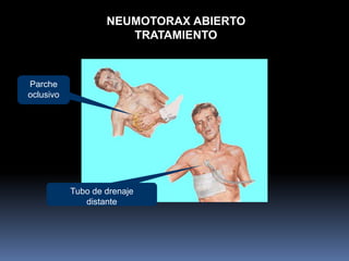NEUMOTORAX ABIERTO
TRATAMIENTO
Parche
oclusivo
Tubo de drenaje
distante
 