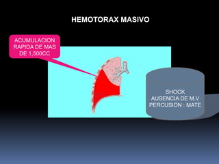 HEMOTORAX MASIVO
ACUMULACION
RAPIDA DE MAS
DE 1,500CC
SHOCK
AUSENCIA DE M.V
PERCUSION : MATE
 