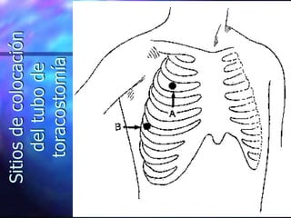 Sitios
de
colocación
del
tubo
de
toracostomía
 
