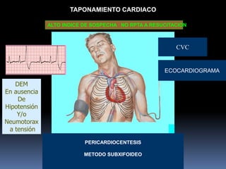 TAPONAMIENTO CARDIACO
CVC
ECOCARDIOGRAMA
PERICARDIOCENTESIS
METODO SUBXIFOIDEO
ALTO INDICE DE SOSPECHA NO RPTA A RESUCITACION
DEM
En ausencia
De
Hipotensión
Y/o
Neumotorax
a tensión
 