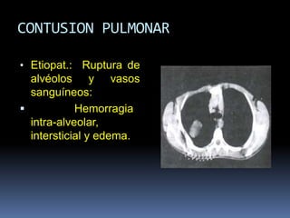 CONTUSION PULMONAR
• Etiopat.: Ruptura de
alvéolos y vasos
sanguíneos:
 Hemorragia
intra-alveolar,
intersticial y edema.
 