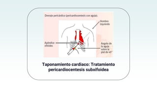 Taponamiento cardiaco: Tratamiento
pericardiocentesis subxifoidea
 