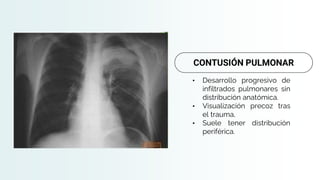 • Desarrollo progresivo de
infiltrados pulmonares sin
distribución anatómica.
• Visualización precoz tras
el trauma,
• Suele tener distribución
periférica.
CONTUSIÓN PULMONAR
 