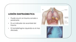 CREDITS: This presentation template was
created by Slidesgo, and includes icons by
Flaticon and infographics & images by Freepik
• Puede ocurrir en trauma cerrado o
penetrante.
• Es un indicador de severidad del
trauma
• El hemidiafragma izquierdo es el mas
afectado.
LESIÓN DIAFRAGMATICA
 