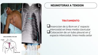 TRATAMIENTO
Inserccion de 5-8cm en 2° espacio
intercostal en línea media clavicular
Colocación de un tubo pleural en 5°
espacio intercostal, línea media axilar
NEUMOTORAX A TENSION
 