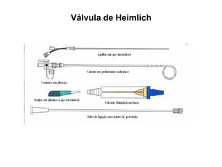 Válvula de Heimlich
 