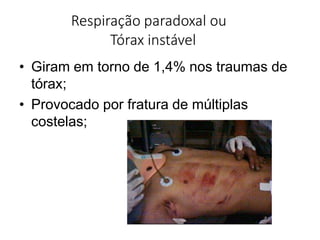 Respiração paradoxal ou
Tórax instável
• Giram em torno de 1,4% nos traumas de
tórax;
• Provocado por fratura de múltiplas
costelas;
 