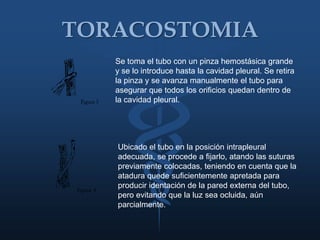 Neumotórax Espontaneo SecundarioMás frecuente en épocas más avanzadas de la vida.Condición potencialmente letal, debido a la asociación de patología parenquimatosa pulmonar difusa.La disnea siempre está presente y por lo general es más severa.