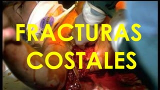 FRACTURAS
COSTALES
 