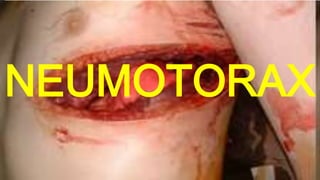 NEUMOTORAX
 