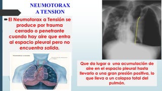 NEUMOTORAX
A TENSION
El Neumotorax a Tensión se
produce por trauma
cerrado o penetrante
cuando hay aire que entra
al espacio pleural pero no
encuentra salida.
Que da lugar a una acumulación de
aire en el espacio pleural hasta
llevarlo a una gran presión positiva, lo
que lleva a un colapso total del
pulmón.
 
