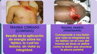 TRAUMA CERRADO
(CONTUSO)
Resulta de la aplicación
de energía sobre los
tejidos, lo cual los
lesiona, sin violar su
integridad.
TRAUMA ABIERTO
(PENETRANTE)
Corresponde a una lesión
que viola la integridad de
los tejidos; en el caso del
trauma de tórax se define
como la lesión que atraviesa
la pleura parietal.
 