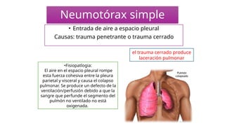 Neumotórax simple
• Entrada de aire a espacio pleural
Causas: trauma penetrante o trauma cerrado
el trauma cerrado produce
laceración pulmonar
•Fisiopatlogia:
El aire en el espacio pleural rompe
esta fuerza cohesiva entre la pleura
parietal y visceral y causa el colapso
pulmonar. Se produce un defecto de la
ventilación/perfusión debido a que la
sangre que perfunde el segmento del
pulmón no ventilado no está
oxigenada.
 