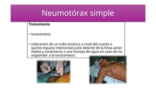 Neumotórax simple
Tratamiento
• toracentesis
• colocación de un tubo torácico a nivel del cuarto o
quinto espacio intercostal justo delante de la línea axilar
media y conectarse a una trampa de agua en caso de no
responder a la toracentesis
 