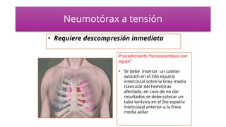 Neumotórax a tensión
• Requiere descompresión inmediata
Procedimiento “toracocentesis con
aguja”
• Se debe insertar un cateter
avocath en el 2do espacio
intercostal sobre la linea media
clavicular del hemitorax
afectado, en caso de no dar
resultados se debe colocar un
tubo torácico en el 5to espacio
intercostal anterior a la línea
media axilar
 