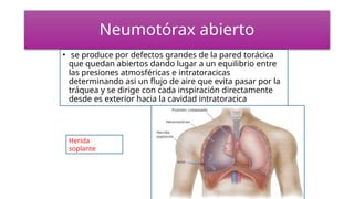 Neumotórax abierto
• se produce por defectos grandes de la pared torácica
que quedan abiertos dando lugar a un equilibrio entre
las presiones atmosféricas e intratoracicas
determinando asi un flujo de aire que evita pasar por la
tráquea y se dirige con cada inspiración directamente
desde es exterior hacia la cavidad intratoracica
Herida
soplante
 