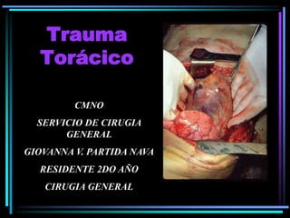 Trauma
Torácico
CMNO
SERVICIO DE CIRUGIA
GENERAL
GIOVANNA V. PARTIDA NAVA
RESIDENTE 2DO AÑO
CIRUGIA GENERAL
 