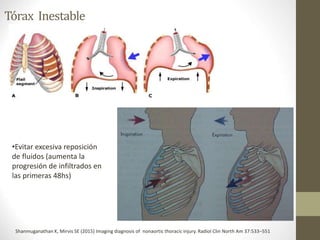 Trauma de torax | PPTX