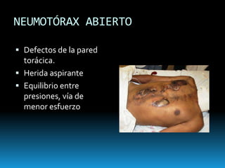OBSTRUCCIÓN DE LA VÍA AÉREATaquipnea + dolor o ansiedadTrauma craneoencefálico*CianosisRetracciones intercostalesRonquera, gorgorismos, estridor
