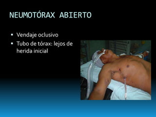 NEUMOTÓRAX A TENSIÓNSe produce un escape de aire unidireccional.Causa colapso de las estructurasCaída del retorno venoso