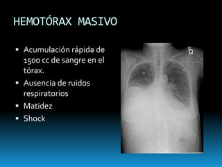 NEUMOTÓRAX A TENSIÓNTráquea desplazadaAusencia de ruidos respiratoriosLimitación movimientos respiratoriosCianosisHemitorax aumentado