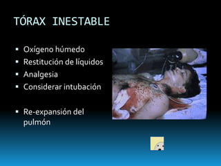 HEMOTÓRAX MASIVOAcumulación rápida de 1500 cc de sangre en el tórax.Ausencia de ruidos respiratoriosMatidez Shock
