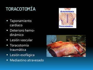 InterescapularTÓRAX INESTABLESegmento de pared pierde continuidadFractura múltiple de costillasRespiración paradójicaContusión pulmonar
