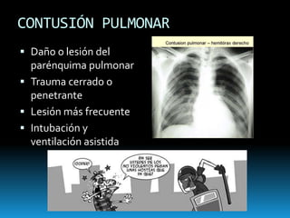 TAPONAMIENTO CARDIACOLesiones penetrantes15-20 cc en pericardioTríada de BeckPulso paradójicoSigno de Kussmaul