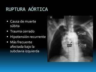 TAPONAMIENTO CARDIACOActividad eléctrica sin pulsoEcografíaECO FAST90% sensibilidad PericardiocentesisviasubxifoideaVentana pericárdicasubxifoidea