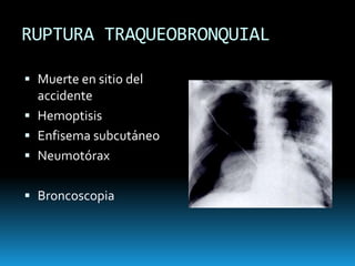 TORACOTOMÍATaponamiento cardiacoDeterioro hemo-dinámico Lesión vascularToracotomía traumáticaLesión esofágicaMediastino atravesado