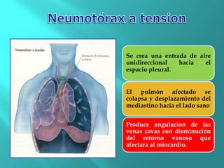 Se crea una entrada de aire
unidireccional hacia el
espacio pleural.
El pulmón afectado se
colapsa y desplazamiento del
mediastino hacia el lado sano
Produce angulacion de las
venas cavas con disminución
del retorno venoso que
afectara al miocardio.
 