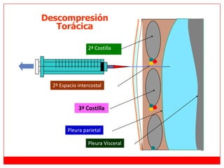 2º Espacio intercostal
2ª Costilla
3ª Costilla
Pleura parietal
Pleura Visceral
Descompresión
Torácica
 