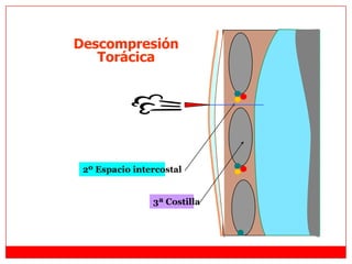 2º Espacio intercostal
3ª Costilla
Descompresión
Torácica
 
