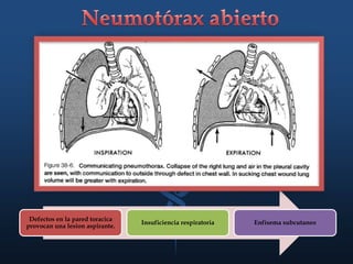 Defectos en la pared toracica
provocan una lesion aspirante.
Insuficiencia respiratoria Enfisema subcutaneo
 