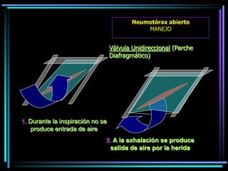 1. Durante la inspiración no se
produce entrada de aire
2. A la exhalación se produce
salida de aire por la herida
Válvula Unidireccional (Parche
Diafragmático)
Neumotórax abierto
MANEJO
 